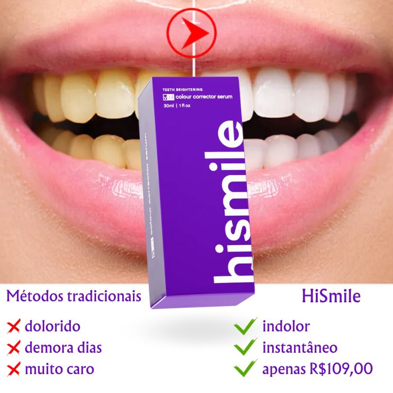 Clareamento Dental Completo com HiSmile